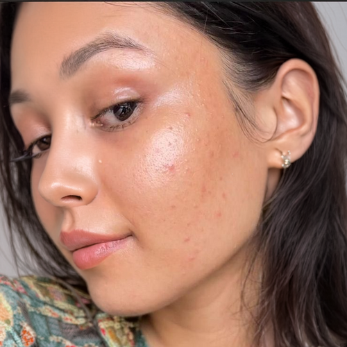 Antes del tratamiento