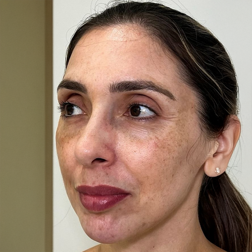 Antes del tratamiento