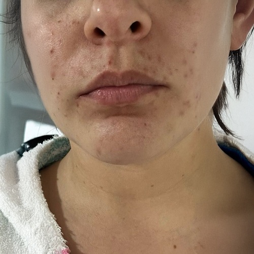 Antes del tratamiento