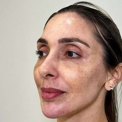 Después del tratamiento