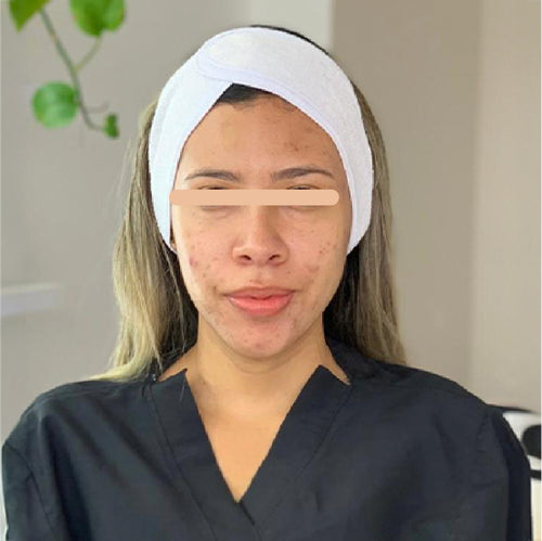 Antes del tratamiento